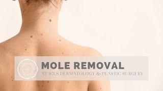 Mole Removal using Shave Excision Technique