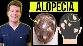 Doctor explains Alopecia Areata (aka patchy or total hair loss) - Signs, Symptoms, Treatment & more