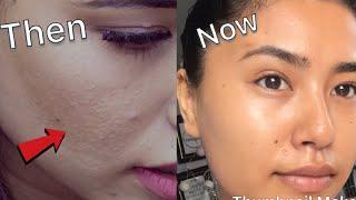 How To Get Rid Of Tiny Bumps On Face | Clear & Smooth Skin Secrets | Beautynepal |