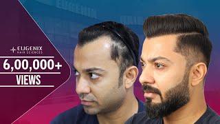 The best Hairline Ever recreated | Best Hair Transplant result | Journey Explained by Patient