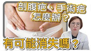 產後的剖腹疤痕、手術疤痕不留身，能做到嗎？莊盈彥醫師帶你來看疤痕治療過程！