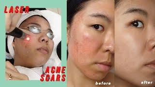 Picosure Laser for Acne Scars & Hyperpigmentation: Before & After