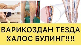 ВАРИКОЗДАН ХАЛОС БУЛИШНИ ИСТАЙСИЗМИ? Буни куринг