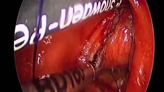 Transanal Minimally Invasive Surgery TAMIS for full thickness excision of an upper rectal neoplasm,