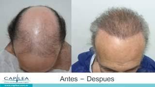 Alopecia grado 7, en paciente de 70 años