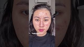 Beginilah kalau punya kulit Acne-Prone Skin