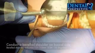 Crown Prep  PFM HD - Dental Perspective