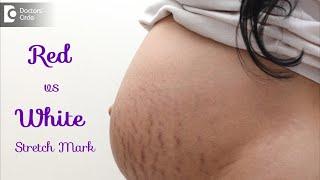 Dark stretch marks & Light stretch marks. Causes & Treatment - Dr. Rasya Dixit | Doctors' Circle