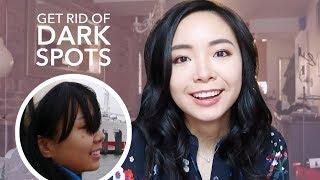 How I got rid of dark spots (sunspots) | Cryotherapy experience, liquid nitrogen | LvL