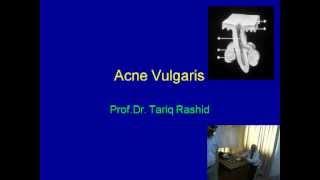 Management of Acne Vulgaris