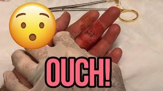 Finger Laceration Triple Feature!