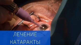 Хирургическое лечение катаракты в ЕМС