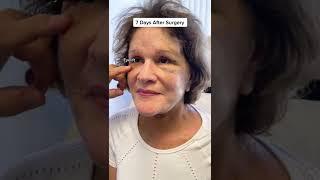 7 Days Post Deep Plane Facelift Surgery