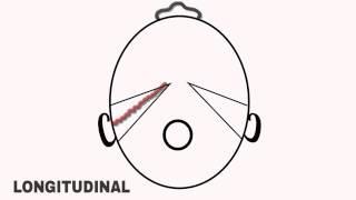 ENT EASY: Temporal Bone fractures made easy to understand:Longitudinal and Transverse