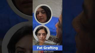 Fat Grafting Immediat Result At Shobhit Aesthetics #despacito #youtubeshorts