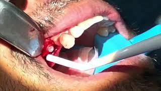 Zirconia Zeramex dental implant placement and simultaneous extractions