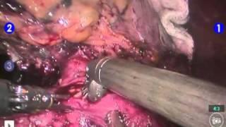 Inferior Vena Cava (IVC) Thrombectomy - da Vinci Robotic Surgery