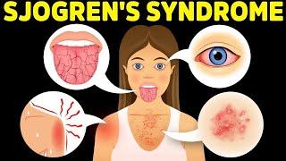 The Best Protocol for Sjogren's Syndrome