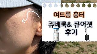 여드름 흉터 쥬베룩 & 큐어젯 내돈내산 후기 | 시크릿, 아이콘 레이저도 받았음 