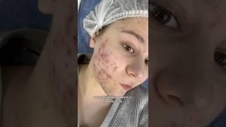ЭТО СЛУЧИЛОСЬ СО МНОЙ #кожа #акне #макияж #здоровье #beauty