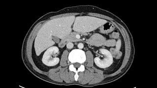 Anatomy of CT scans: Abdomen