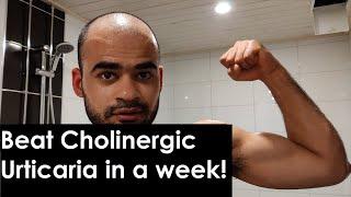 Beat CHOLINERGIC URTICARIA in a WEEK!