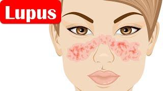 Lupus (SLE/Systemic Lupus Erythematosus) - Causes, Pathogenesis, Symptoms, Diagnosis, Treatment
