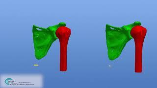 Total Shoulder Arthroplasty planning from MRI by RSIP Vision