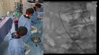 TAVI For Severe AS Using 29 MM Evolut PRO