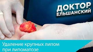 Удаление крупных липом при липоматозе Removal of lipomas in multiple lipomas (lipomatosis)