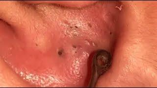 UNBELIEVABLE !!! AN EAR FULL OF BLACKHEADS... SATISFYING VIDEO #3 #relaxing #blackheads