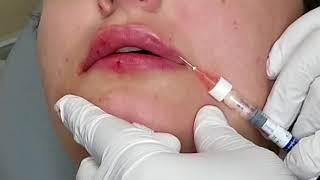 Lip Filler Injection, Enhance Lips and Contouring, Elite Medical Aesthetics, Rocklin