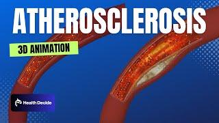 Atherosclerosis - 3D Animation