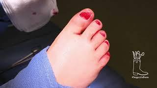 This little piggy: Onychomycosis