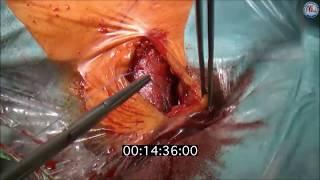 Transcarotid approach for TAVI: an optimal alternative to the transfemoral gold standard