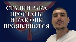 Стадии РАКА ПРОСТАТЫ и как они проявляются