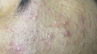 Acne treatment for Spa Linh Mun 2023 #095