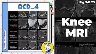 (Fig 5-B.23) ICRS Staging System of Osteochondritis Dissecans