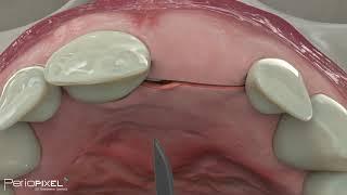 Avance del vídeo completo "Colocación de implante unitario" - PerioPixel