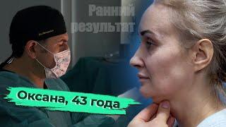 Омоложение лица: Оксана, 43 года