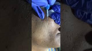 DPN Treatment at Skinaa Clinic #DPN #dpntreatment #ytshorts #viral #shorts #skinaaclinic #dpn