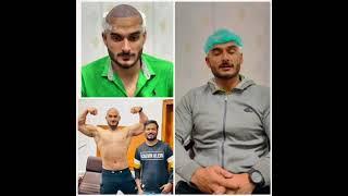 asad hameed FUE hair transplant 03236375419￼