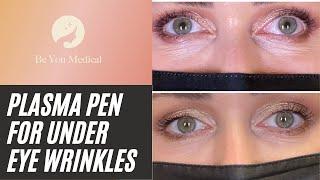 Plasma Pen for Under Eye Wrinkles