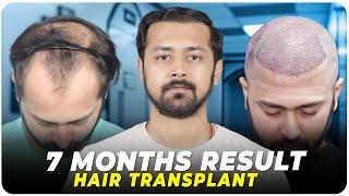 Hair Transplant in India | Best Results & Cost of Hair Transplant in India