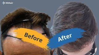 Hair transplant time lapse: Before and after