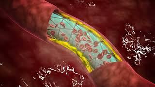 Transcarotid Artery Revascularization (TCAR)