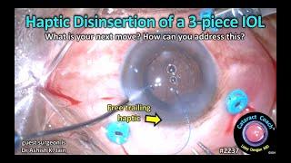 CataractCoach™ 2237: haptic disinsertion of a three-piece IOL