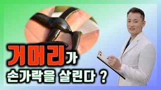 수지접합과 장해판정(1~4부) 1부: 거머리가 손가락을 살린다