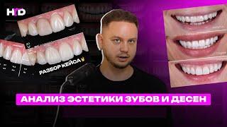 Анализ эстетики зубов и десен | PROвиниры Прокопович Виктор