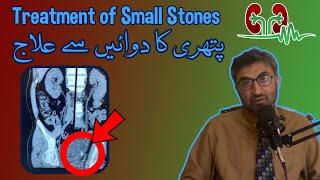 Treatment of Tiny Stones Without Surgery | Dr. Shoaib Mithani